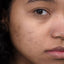 Link between Acne and Mental Health: Understanding the Psychological Impact of Acne
